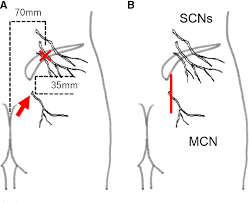The nerve blocks were administered to 25 individuals who presented medial and superior cluneal nerve entrapment symptoms. Figure 3 From Low Back Pain Due To Middle Cluneal Nerve Entrapment Neuropathy Semantic Scholar