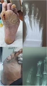 Image result for Probe-to-Bone Test