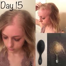 Is hair loss around radiation treatment normal?