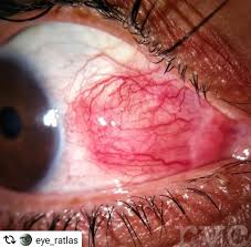 Image result for Scleritis