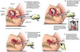 Seperti yang kita ketahui, buah durian sangat dilarang bagi ibuhamil. Pengalaman Kandungan Luar Rahim Ectopic Pregnancy