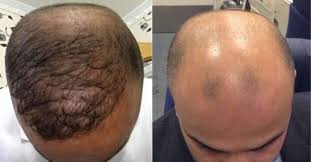 Oggi con il trapianto capelli in turchia, ed un prezzo accessibile, puoi tornare a stare bene. Il Trapianto Di Capelli In Turchia L Ultima Frontiera Dei Pelati Soprattutto Arabi Dagospia