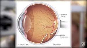 Your retina could tear before it detaches. Retinal Detachment Symptoms And Causes Mayo Clinic