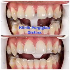 Klinik veterinar hanya akan mengambil kes temujanji sahaja sepanjang pkp ini. Klinik Pergigian Qistina Close Ur Teeth Gap With Us Klinikpergigianqistina Teethgap Gigijarang Gigicantik Gigiputih Crowning Smilesofmalaysia Aestheticdentistry Dentist Dentalmakeover Whitening Teethwhitening Doktorgigi