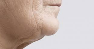 Stay in that position for 5 seconds or a count of 10. Jowls Exercises Causes Treatment And Prevention