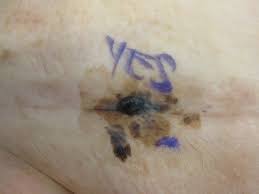 Each individual is unique, so survival rates, treatments and symptoms vary by pati. Melanoma Malignant Melanoma Dermatology Advisor