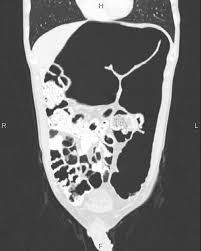 Image result for Megacolon