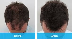 In men, hair often begins to recede at the hairline on the forehead. Hair Loss Treatments For Men Gold Coast Brisbane Medici Capelli