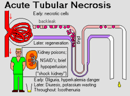 Pin By Ihab Khattaby On Nephrology Kidney Kidney Disease Nsaids