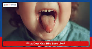 Image result for papillomavirus tongue)