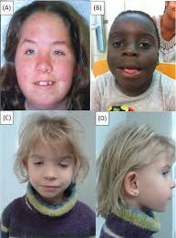 Facial features of children with FASD. (A) Caucasian girl with short...