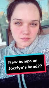 Jocelyn Head Injury
