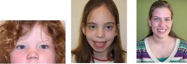 Background down syndrome, typically caused by trisomy 21, may also be associated by duplications of the down syndrome critical region (dscr) on chromosome 21q22. Trisomy X Wikipedia