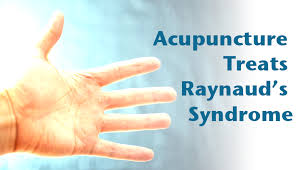 Use Acupuncture To Treat Raynaud S Syndrome Han S Chiropractic Acupuncture Palatine