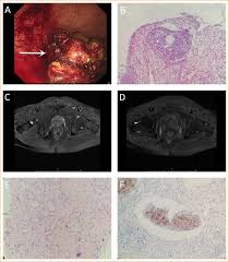 Another condition that can be misdiagnosed as cancer in the colon is hemorrhoids. Prostate Cancer Invading The Rectum Misdiagnosed As Rectal Cancer The American Journal Of The Medical Sciences