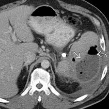Image result for Splenic Abscess