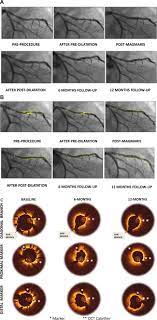 Safety and clinical performance of a drug eluting absorbable metal scaffold  in the treatment of subjects with de novo lesions in native coronary  arteries: Pooled 12‐month outcomes of BIOSOLVE‐II and BIOSOLVE‐III -