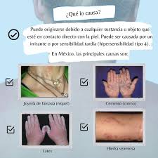 Image result for dermatitis contacta toxica