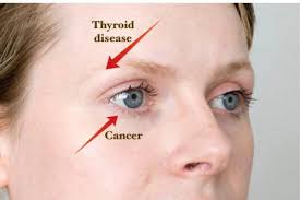 These tumors tend to happen more often in people who are in their 30s. 14 Things Your Eyes Can Tell You About Your Health If You Know What Look For Eye Health Health Signs Health