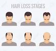 Hair Loss Men Treatment