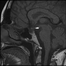 Image result for Incidental Imaging Finding
