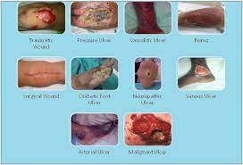 The wound care manual promotes a collaborative approach to the assessment and management of people with wounds and provides information on wound cleansing agents and all types of dressings. Https Www Moh Gov My Moh Resources Penerbitan Garis 20panduan Garis 20panduan 20umum Kkm Wound Care Manual Pdf