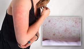 There isn't a permanent fix, but you can make the bumps go away for a while with glycolic and lactic acid treatments, which will diminish buildup and make your. How To Get Rid Of Small Red Bumps At The Top Of Your Arms What Is The Condition Express Co Uk