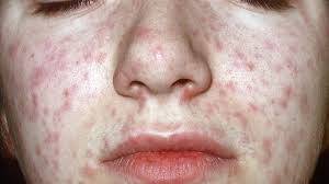 Image result for red rash face