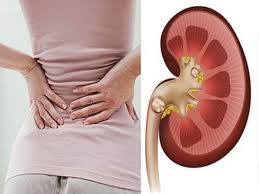 Káº¿t quáº£ hÃ¬nh áº£nh cho triá»‡u chá»©ng Ä‘au lÆ°ng