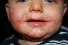 Jika anak anda mempunyai tanda ini, segeralah bawa mereka ke hospital. Virus Hfmd Turut Jangkiti Orang Dewasa 10 Rawatan Ini Boleh Bantu Theasianparent Malaysia