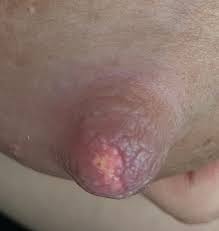 You can also use your hands to pressure the milk out. Milk Blister I Think That Won T Go Away Breastfeeding Forums What To Expect