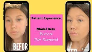 I used the restroom before the procedure because i was nervous. Supermodel Buccal Fat Removal Patient Experience Life Changing Youtube