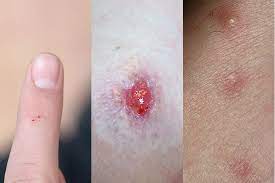 Doctor said he thinks it looks like inflammation still from the infection, but as i have not had any trauma or i too am really worried woke up yesterday morning with two large red marks resembling bite like marks, very. Identifying Common Summer Bug Bites