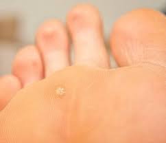 Calos Nos Pés Olho De Peixe Calo No Pe Planters Wart Warts Planter Warts Remedies