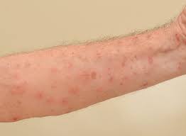 Image result for scabies symptoms