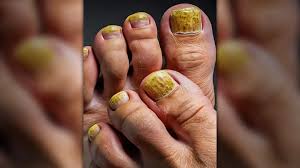 Image result for Yellow nail syndrome feet