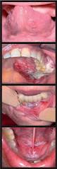 Image result for dental cancer
