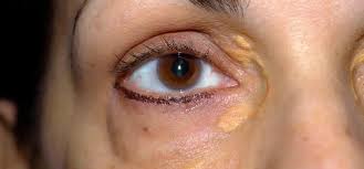 Image result for xantelasma