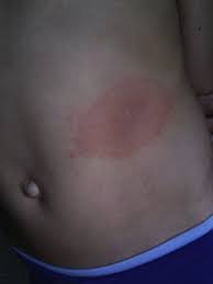 Igm antibody results against b burgdorferi should only be considered. Borrelia Burgdorferi Infection And Lyme Disease In Children International Journal Of Infectious Diseases
