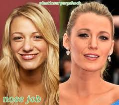 Blake Lively Plastic Surgery Before And After Nose Job Blake Lively Plastic Surgery Nose Job Plastic Surgery