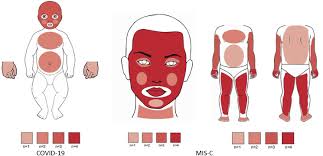 Fever (100.4 degrees fahrenheit or higher) lasting 24 hours or more. Mucocutaneous Disease And Related Clinical Characteristics In Hospitalized Children And Adolescents With Covid 19 And Multisystem Inflammatory Syndrome In Children Journal Of The American Academy Of Dermatology