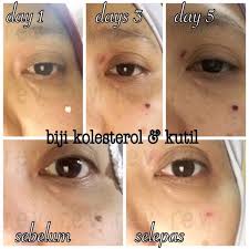 Cara hilangkan bintik kolestrol di bawah mata tanpa rasa sakit dan mudah diarinutrisi com. Biji Kolestrol Removal Cream Shopee Malaysia