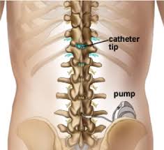 Image result for Intrathecal Pump
