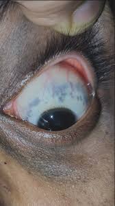 Image result for nevus sclerae