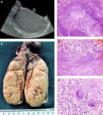 Image result for Genitourinary Tuberculosis
