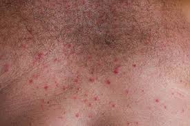 Image result for sweat rash on back