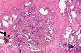 Hyperplasia Definition Causes Types And Quiz Biology Dictionary