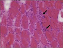 Image result for Polymyositis
