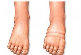 odem nedir neden olur iste odemi atmak icin dogal cozumler saglik haberleri