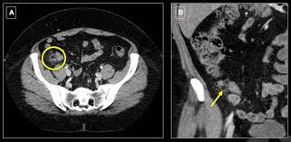 Modern living room tables images and appendices epiploicae symptoms. Epos Trade